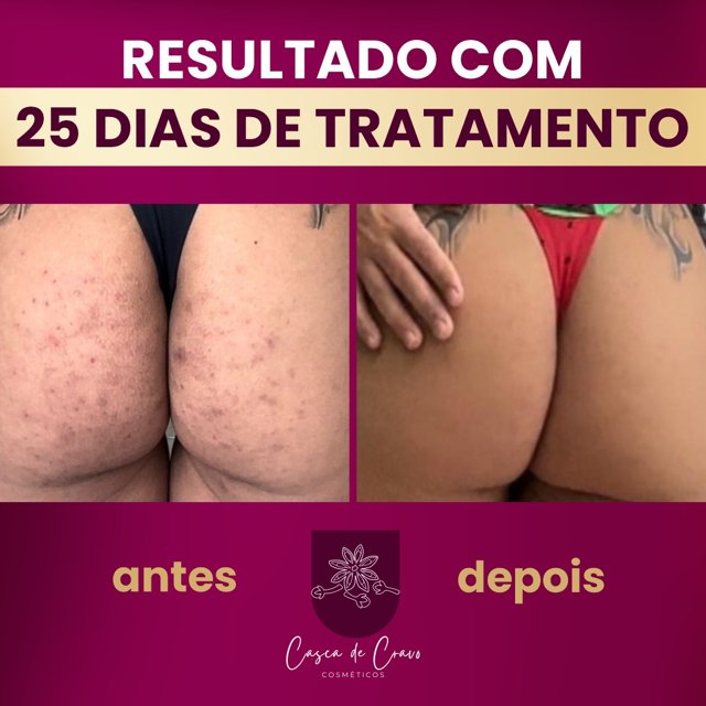 Tratamento Para Manchas de Foliculite Axilas Virilhas