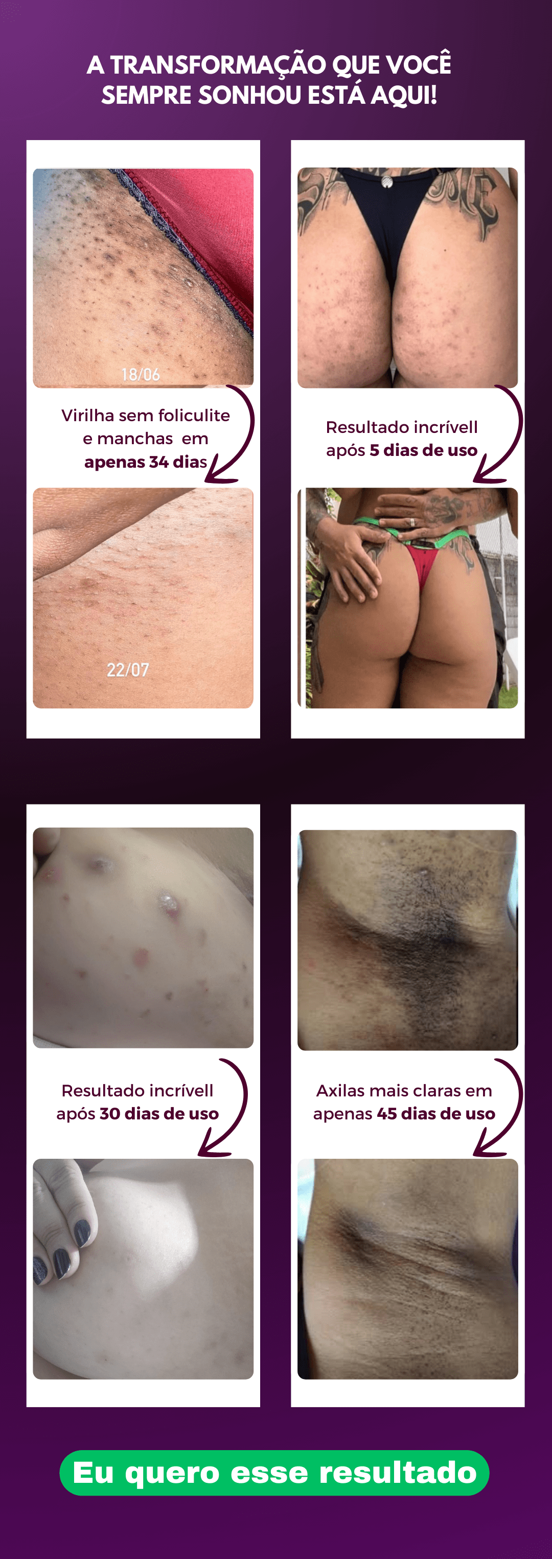 voce-tem-vergonha-de-mostrar-sua-pele-diga-adeus-a-foliculite-e-as-manchas-escuras-e-volte-a-se-sentir-confiante-destaques-resultados-visiveis-em-poucos-dias-100-vegano-e-dermatologi